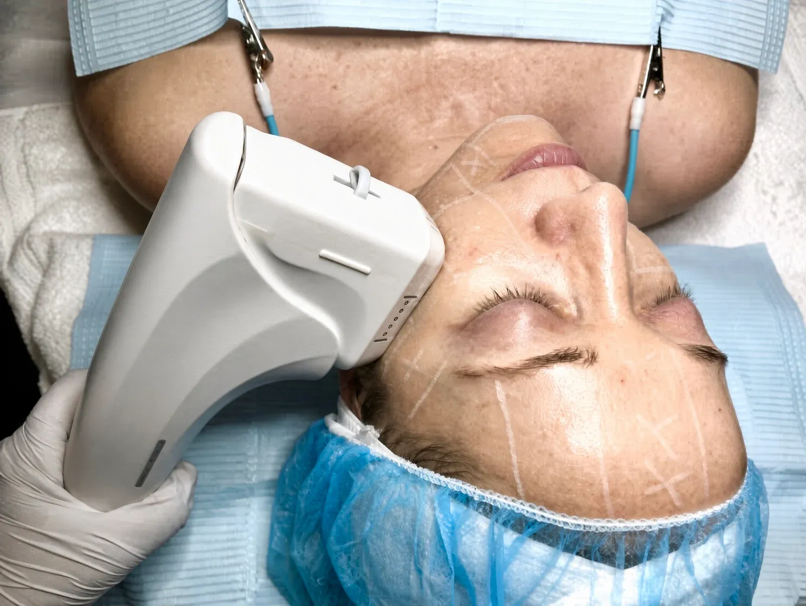 A HIFU handpiece on a client's cheek, with guide lines drawn on the skin, during a session at Studio B