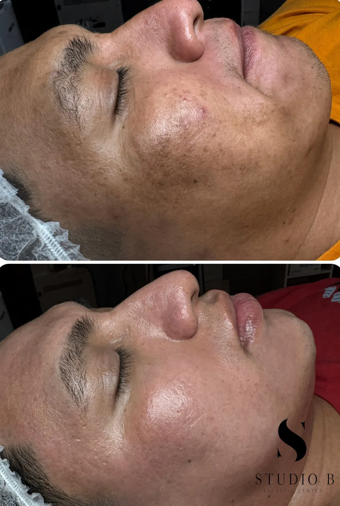 Before and after Cosmelan: above, the cheek with dark spots; below, a more even tone