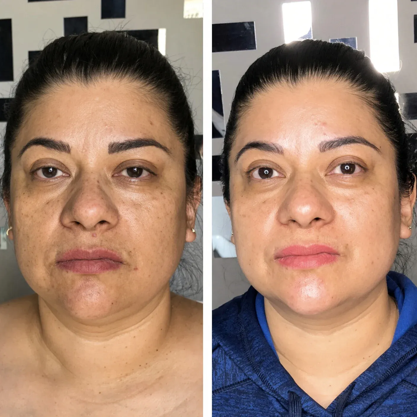 Before and after a dark spot treatment at Studio B: the same face from the front, with dark spots on the left and a more even tone on the right