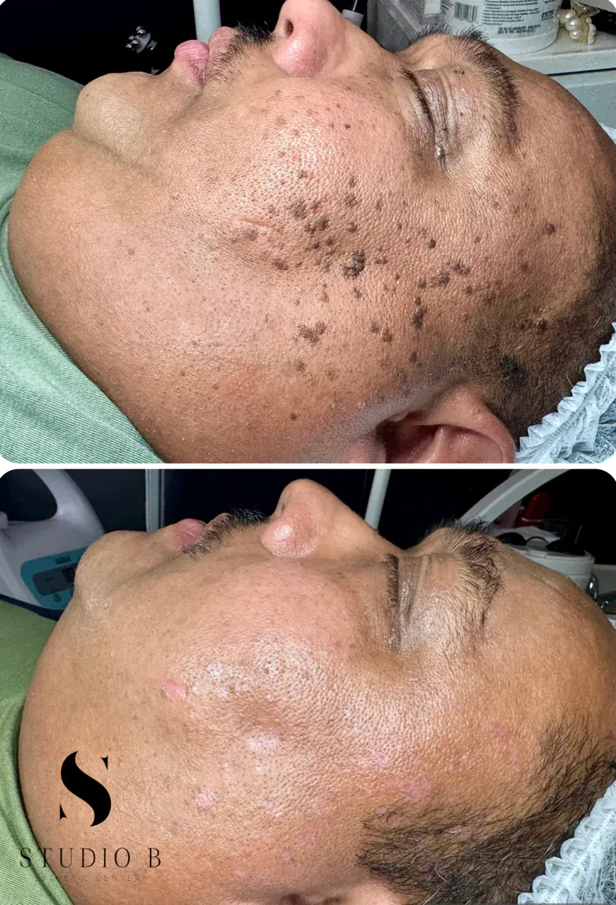 Before and after wart removal on the cheek: warts above, clear skin below